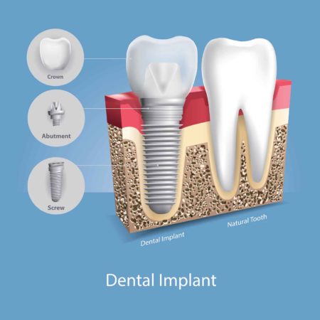 A dental implant adjacent to a natural tooth