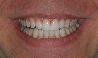 a patient's new smile after Invisalign