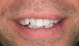 an image of patient's smile before Invisalign