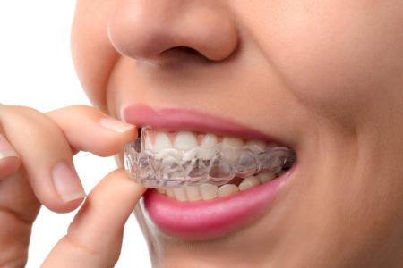 Woman putting in an Invisalign tray