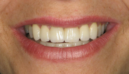 a patient with a beautiful smile after porcelain veneers