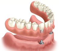 snap-on dentures, which are affordable dental implants 
