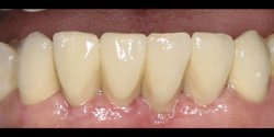 teeth after a dental bridge