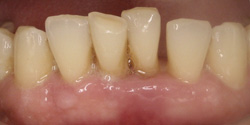 teeth before a dental bridge