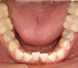 a mouth after crowns