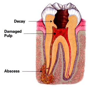 emergency dentist illustration of a dental abscess