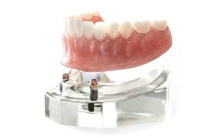 a lower set of implant dentures