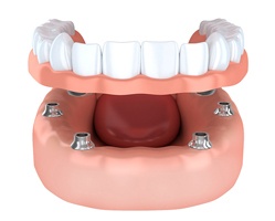 a set of implant dentures snapping into place