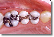 a row of teeth with amalgam fillings before patient sees a mercury-free dentist