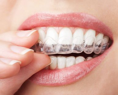 teeth whitening trays being placed over teeth
