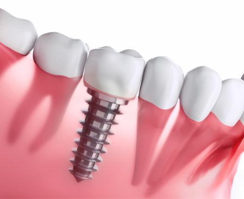Model of a lower molar dental implant surrounded by natural teeth
