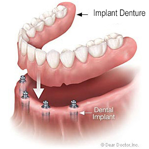 Diagram of lower-jaw dental implants with a denture hovering above them