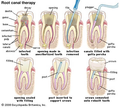Diagram of root canal therapy for a comparsion of root canal and extraction with a dental implant