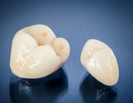 Two dental crowns, for information on cavity beneath dental crowns