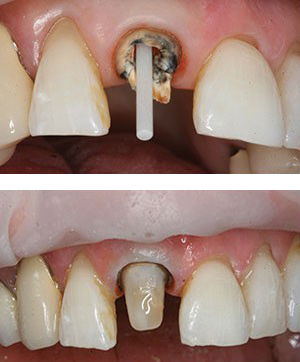 Dental post in tooth in upper photo and a built up tooth lower photo