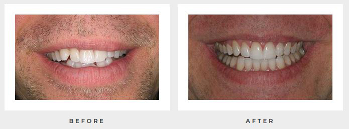 Before and after chipped teeth photos from Rocky Hill dentist Dr. Michalski