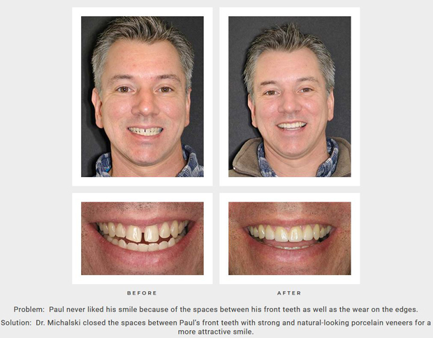 Before and after porcelain veneers photos from Rocky Hill/Hartford dentist Dr. Michalski