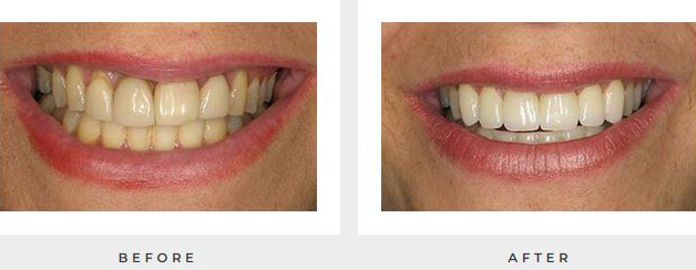 Before and after porcelain veneer photos of a woman's smile from Dr. Michalski in Rocky Hill, CT