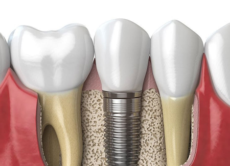 A dental implant, for information on pregnancy and dental visits to prevent tooth removal and an implant