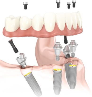 Model of a lower denture for All-on-4 dental implants
