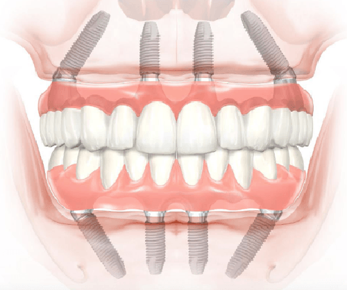 Diagram of All on 4 dental implants