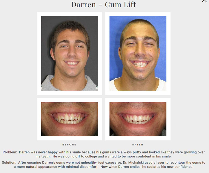 Before and after gummy smile treatment photos from Hartford CT area cosmetic dentist Dr. Michalski