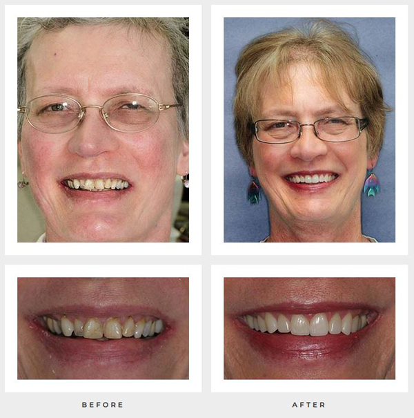 Before and after crowns front teeth photos from Dr. Michalski of Rocky Hill