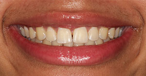 a patient after gum recontouring