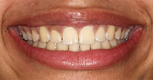 a patient before gum recontouring