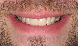 a patient's new smile after Invisalign