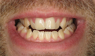 an image of patient's smile before Invisalign