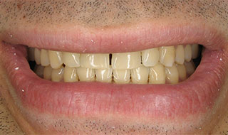 a patient before teeth whitening