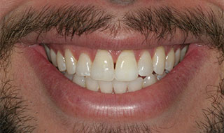 a patient before teeth whitening