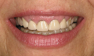 a patient before full mouth reconstruction
