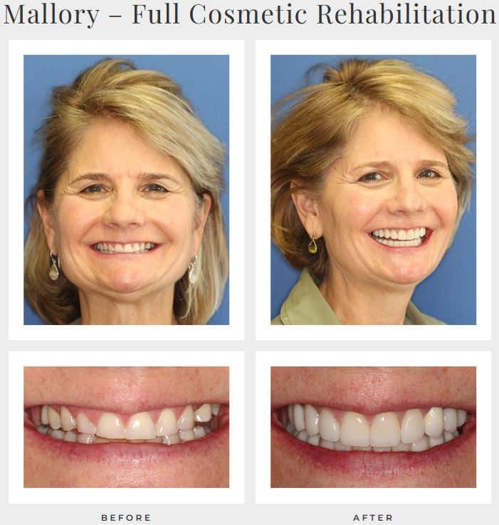 Full-mouth rehab with dental crowns