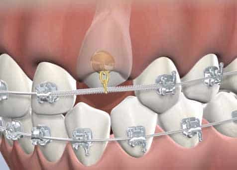 Digital side-view of an impacted canine tooth and races on upper and lower teeth. A chain is guiding the canine into place