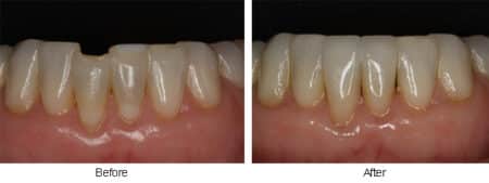 Lower chipped incisor before and after pictures