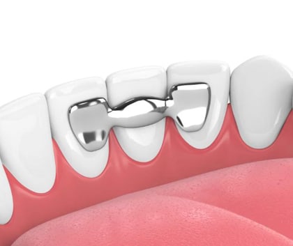 The back side of lower teeth with a Maryland bridge replacing an incisor