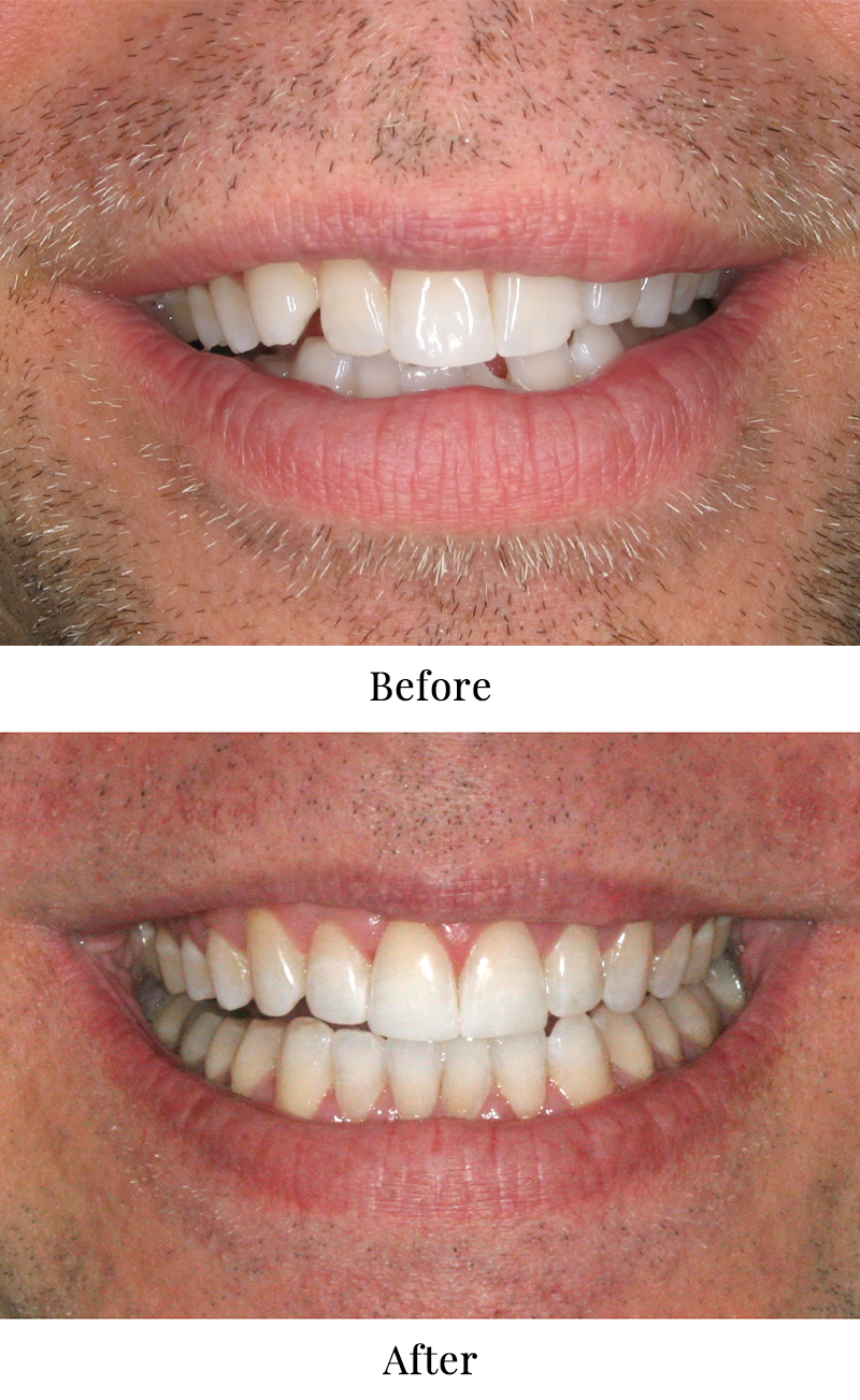 Two photos showing a man's smile before and after cosmetic bonding treatment.