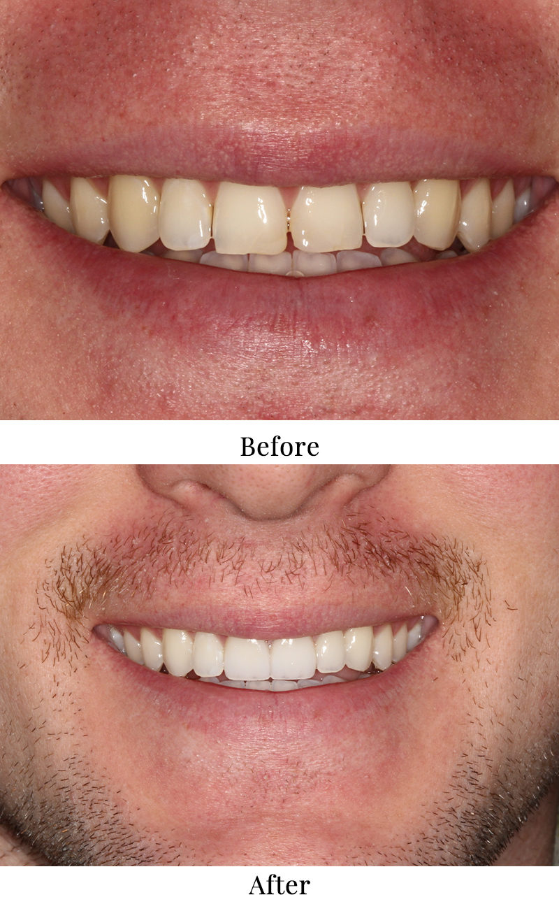 Two photos showing a man's smile before and after teeth whitening treatment.